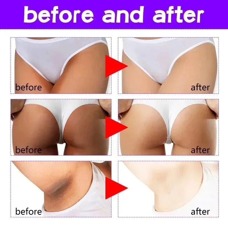 Remove Dark Melanin Whitening Cream Private Parts Underarm Bleaching Serum Whiten Butt Knee Brighten Inner Thigh Intimate Parts